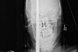 鱼叉误伤少年头部—X光影像