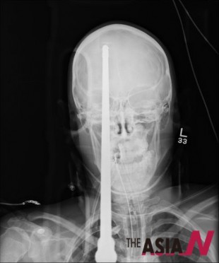 鱼叉误伤少年头部---X光影像